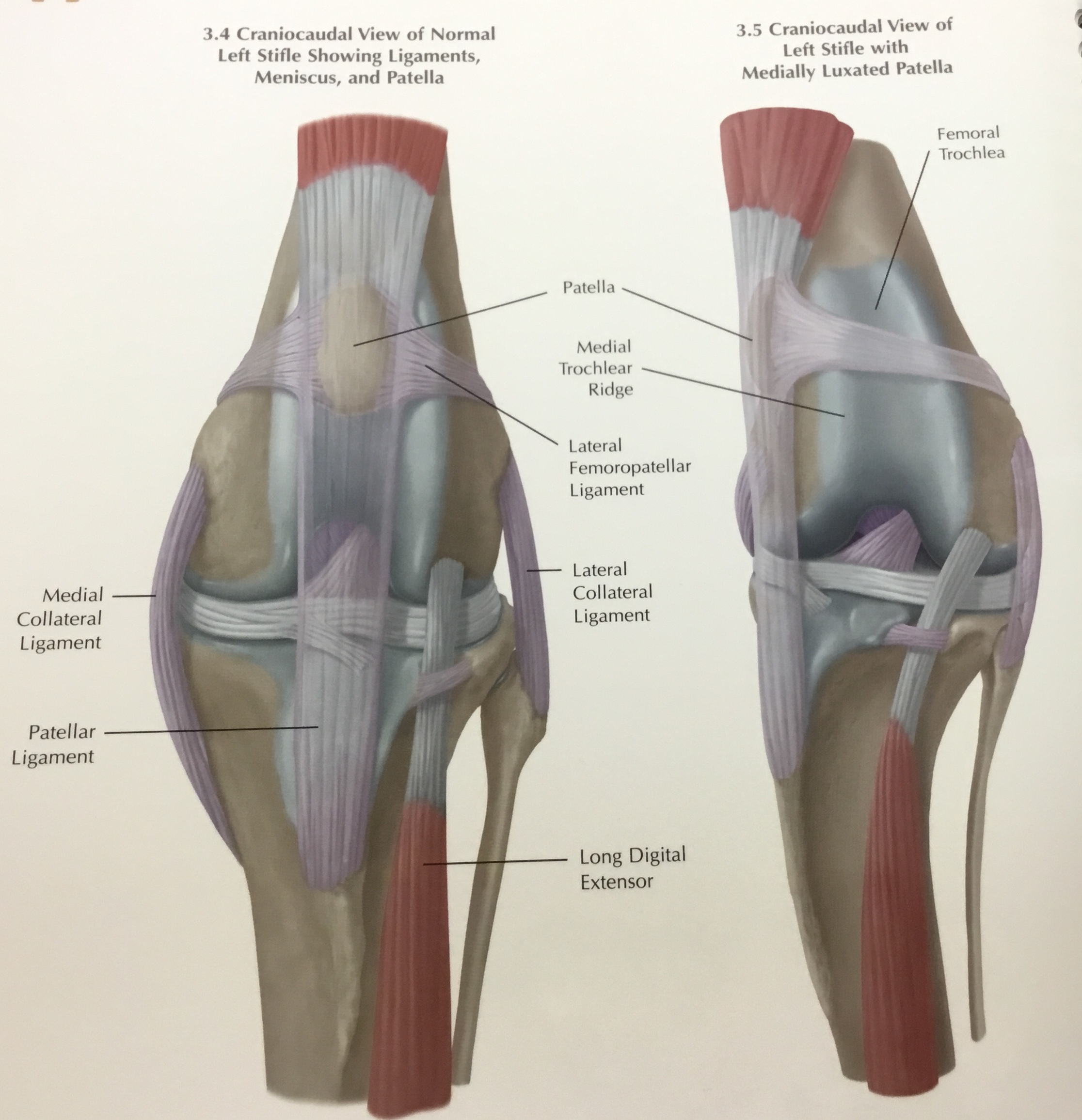 Luxating store patella human